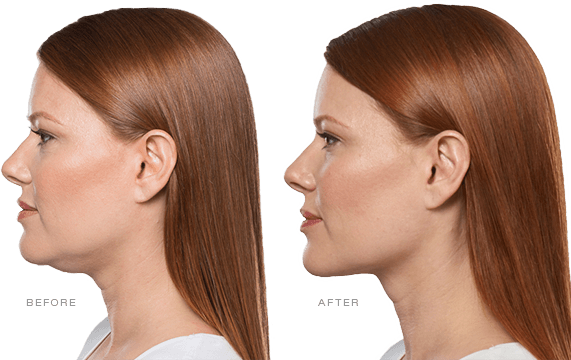 AboutKybella (1) (1) (1).png