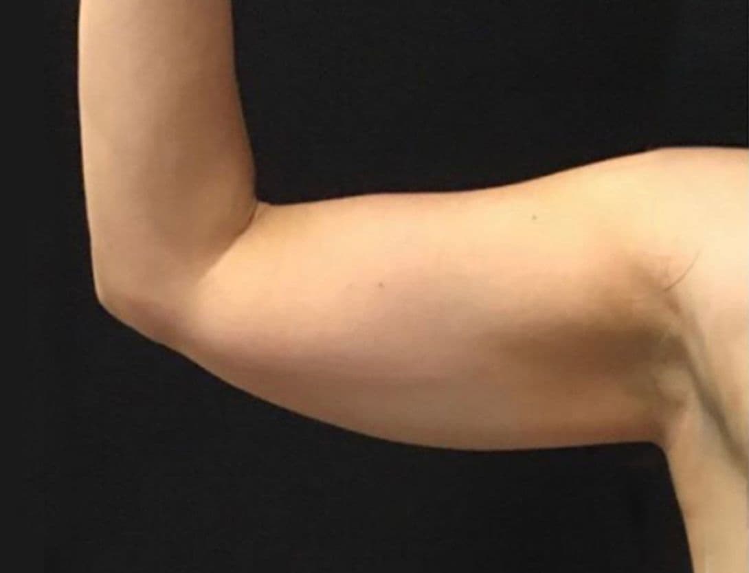 CoolSculpting after