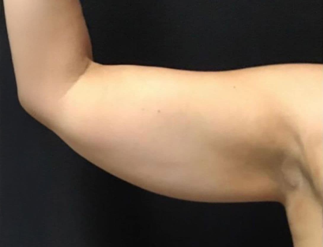CoolSculpting
