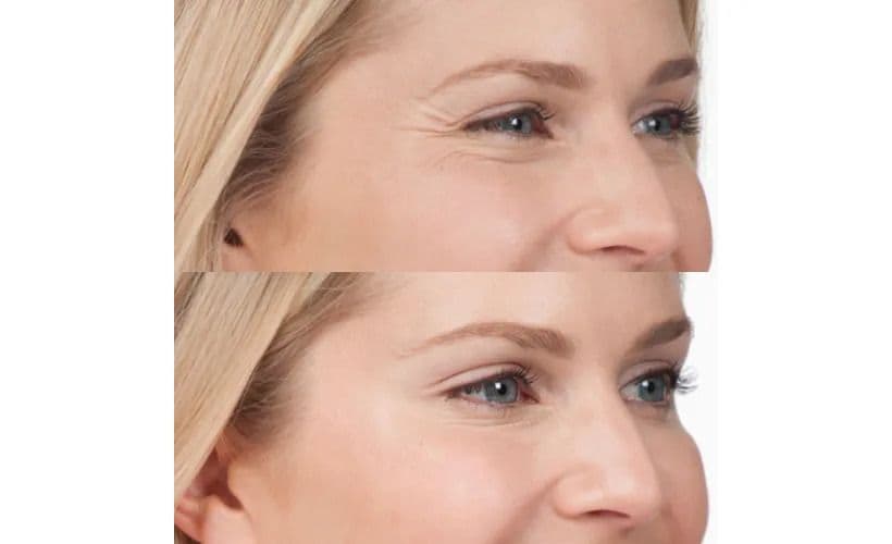 Botox-Before-and-after-revive-med-spa-3.jpg