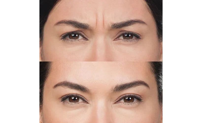 Botox-Before-and-after-revive-med-spa-4.jpg