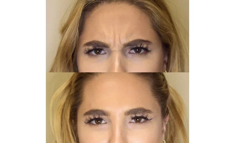 Botox-Before-and-after-revive-med-spa.jpg