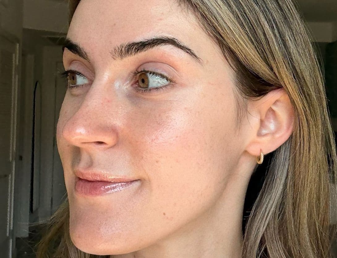 woman's face after microneedling treatment