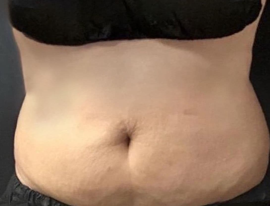 CoolSculpting-After.jpg