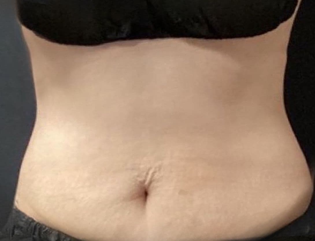 CoolSculpting-Before.jpg