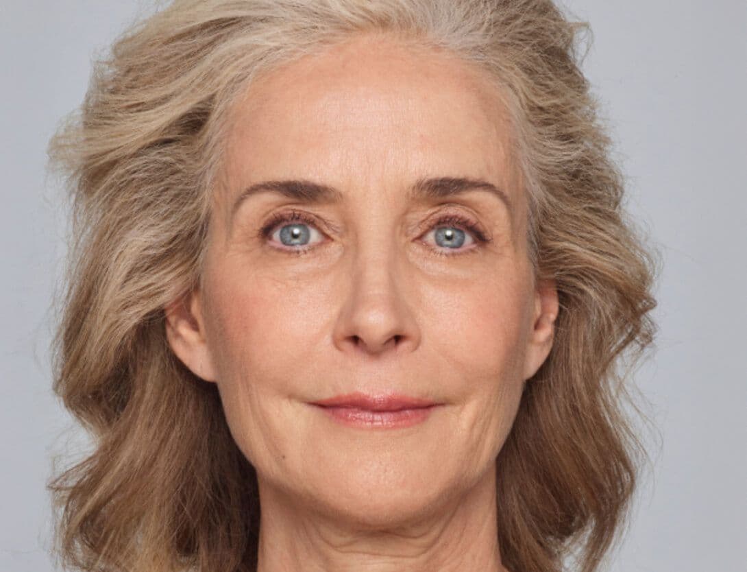 Dermal Fillers-1-After.jpg