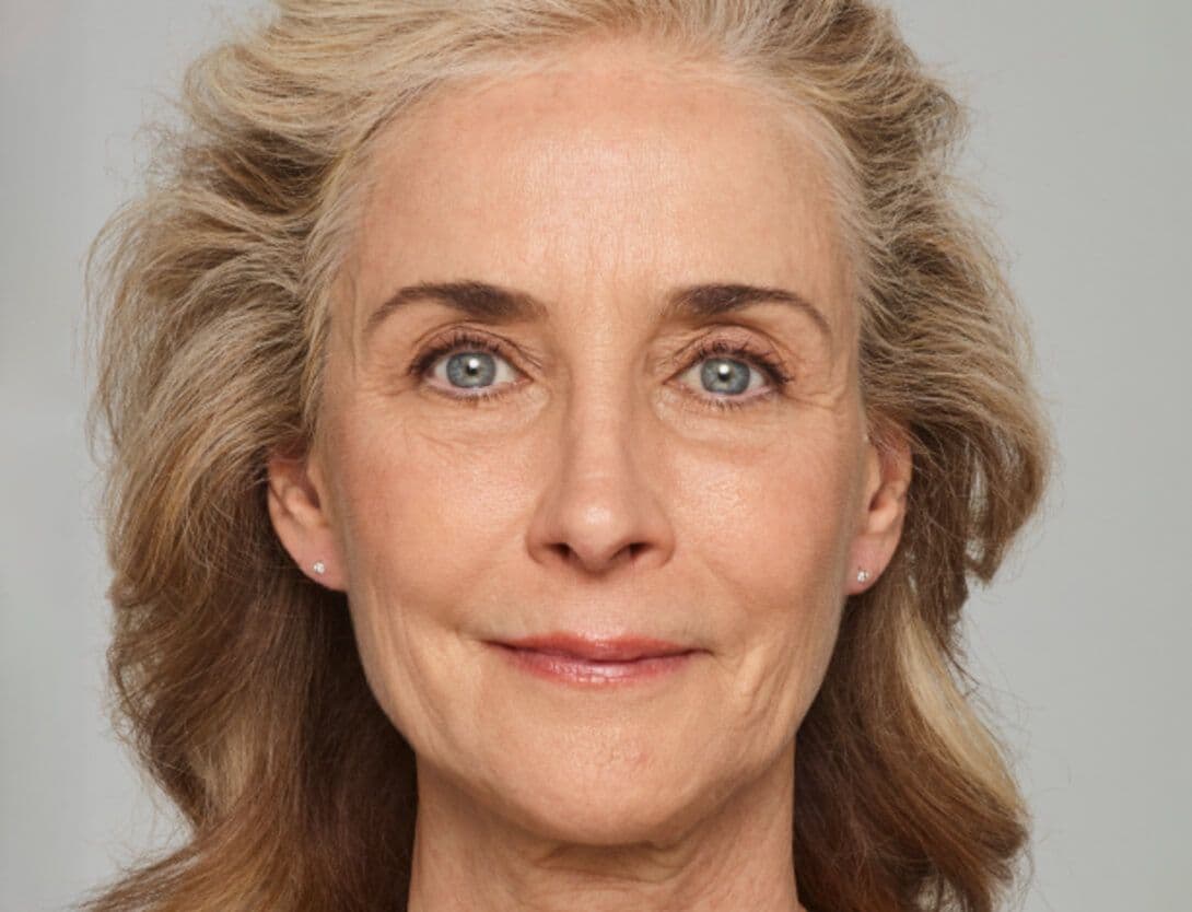 Dermal Fillers-1-Before.jpg