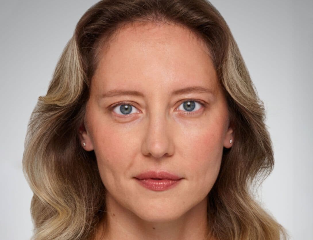 Dermal Fillers-2-Before.jpg