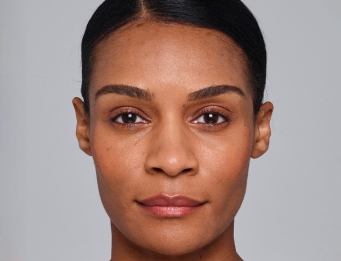Dermal Fillers-3-After.jpg