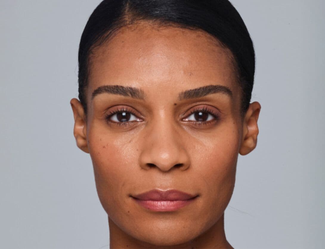 Dermal Fillers-3-Before.jpg
