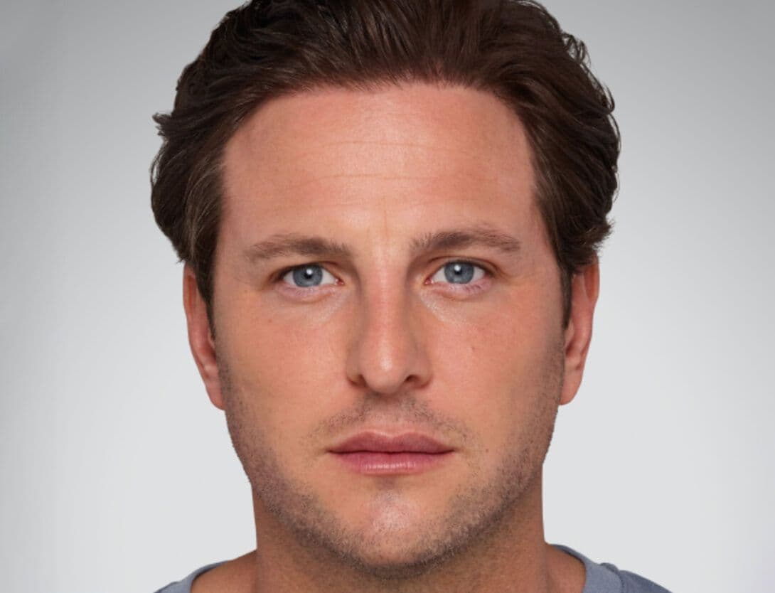 Dermal Fillers-4-Before.jpg