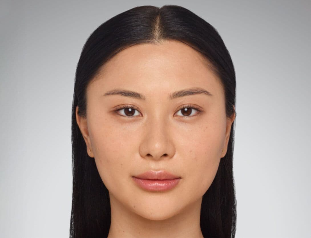 Dermal Fillers-5-After.jpg