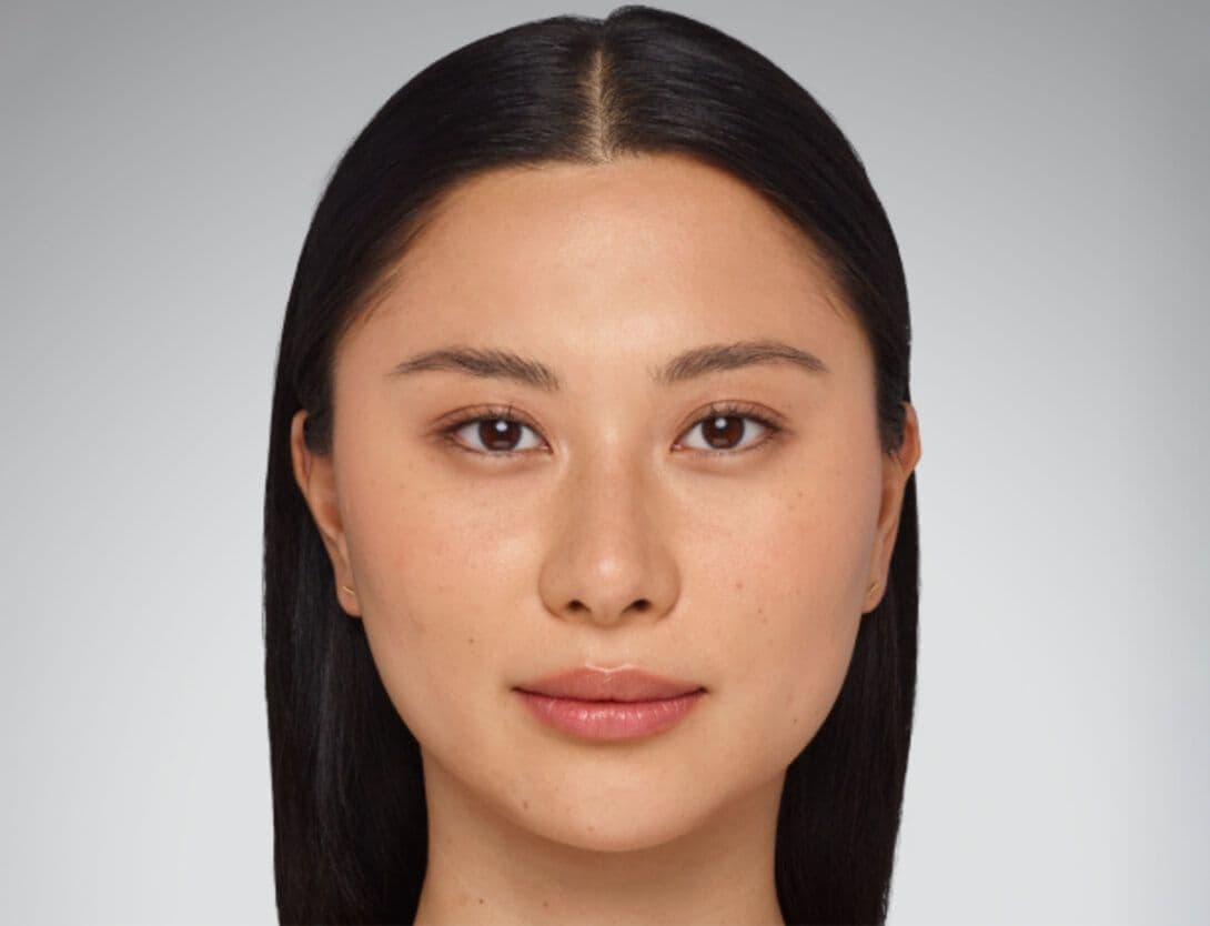 Dermal Fillers-5-Before.jpg