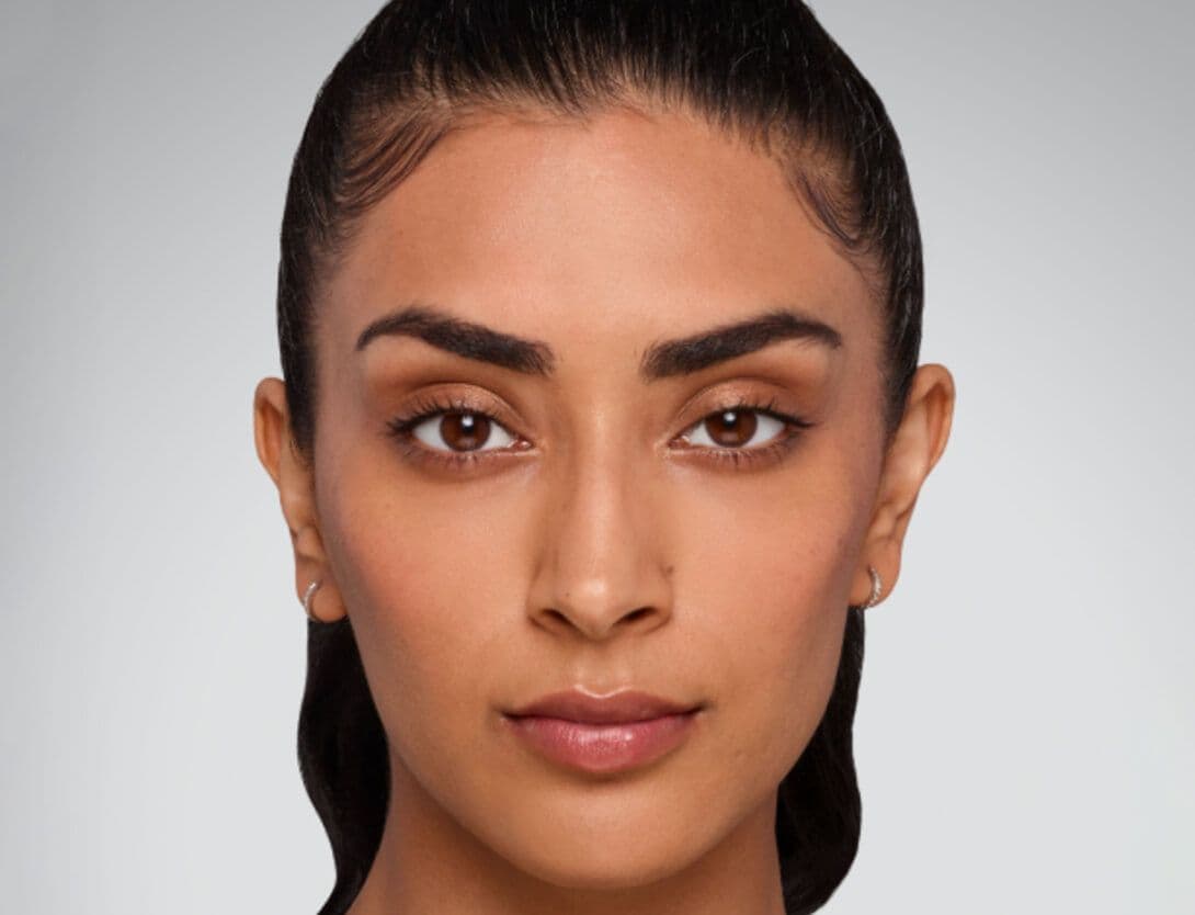 Dermal Fillers-6-After.jpg