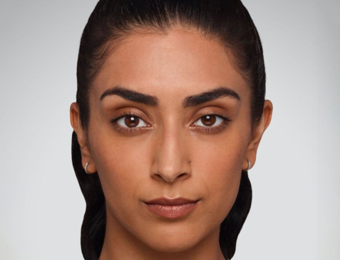 Dermal Fillers-6-Before.jpg