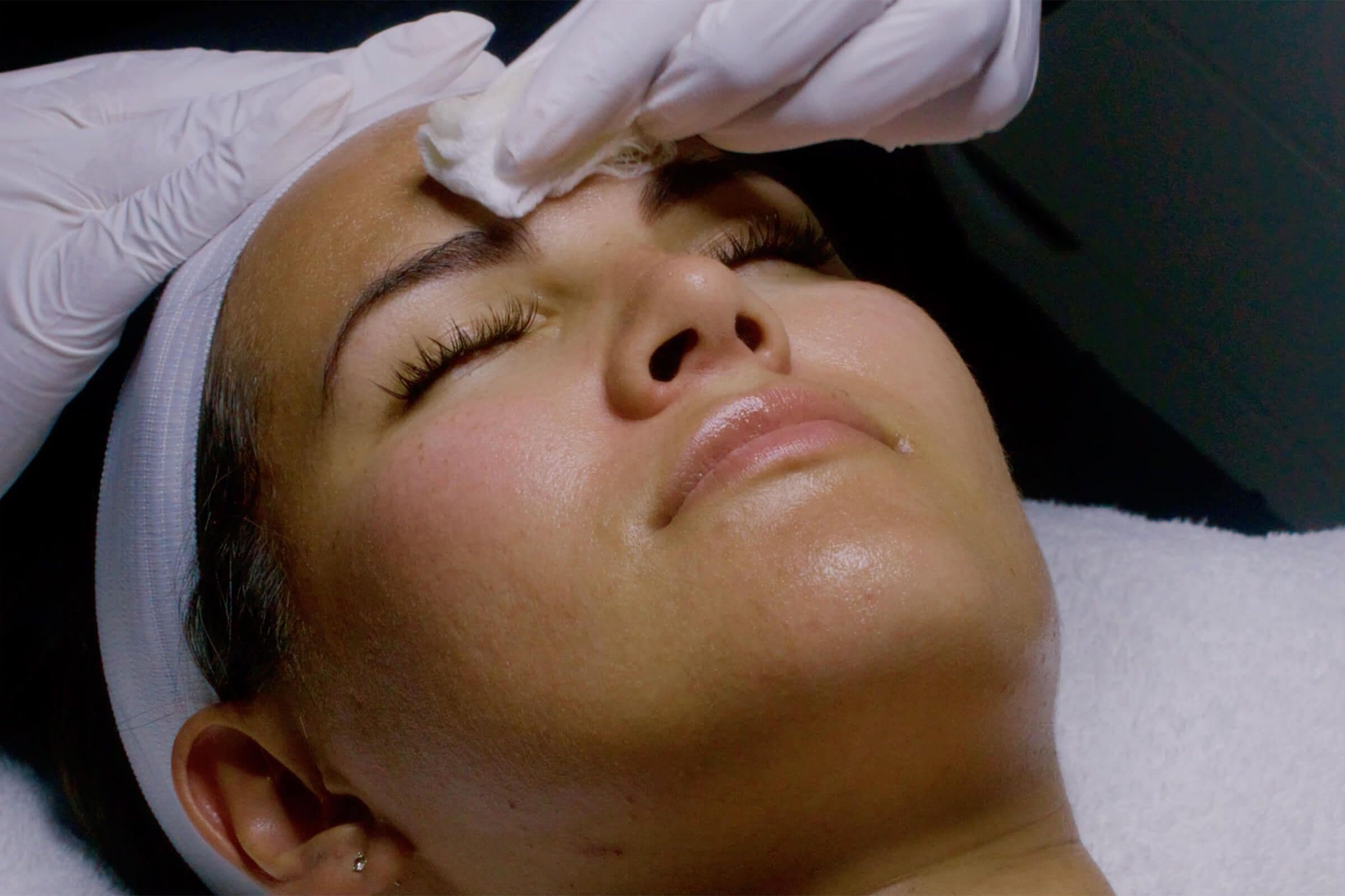 ChemicalPeel