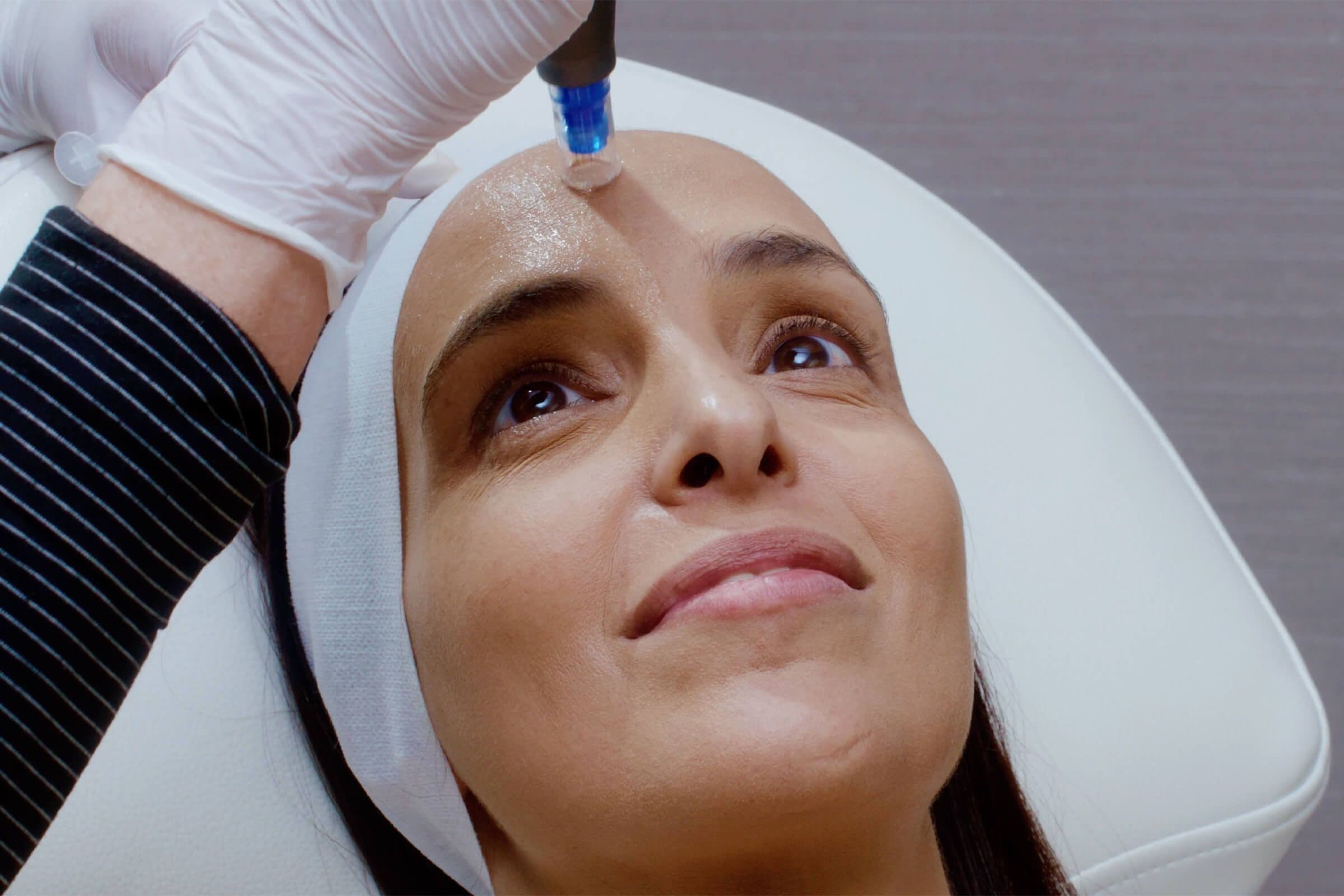 Microneedling