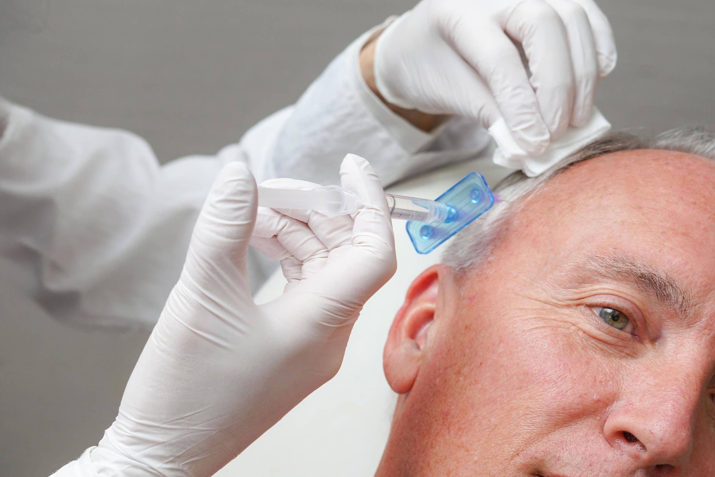 -PRP-Hair-Restoration