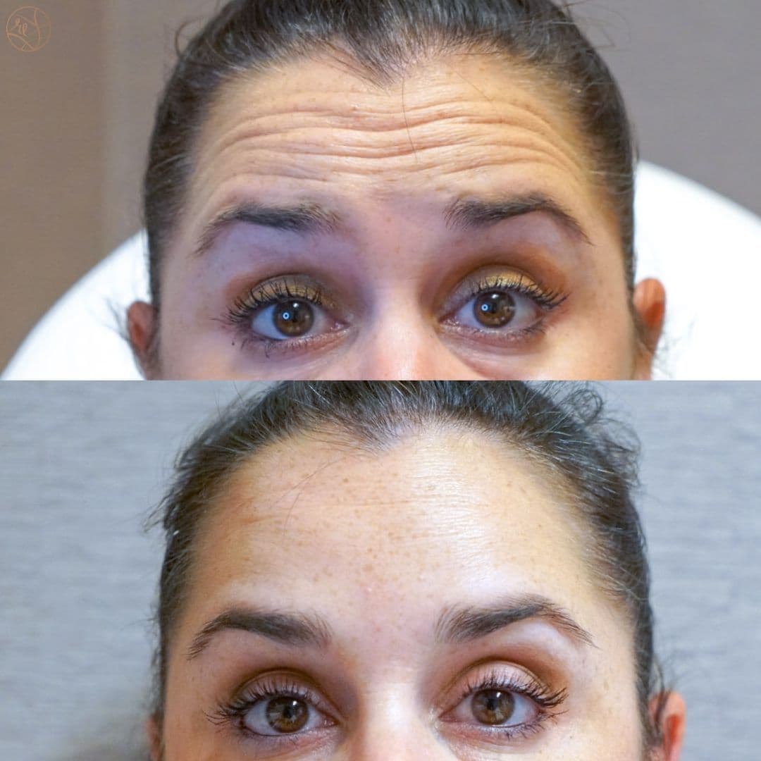 KatieBotoxForeheadB&A (1).jpg