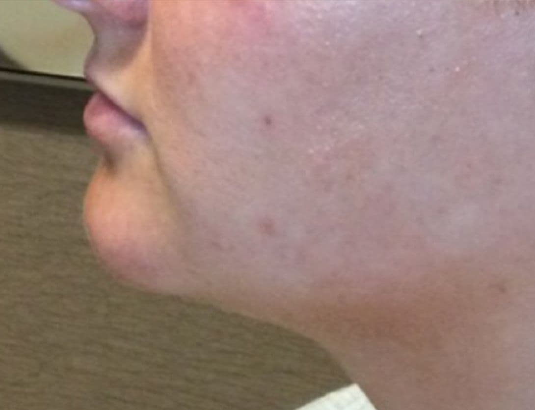 KybellaB&AOct7-After.jpg