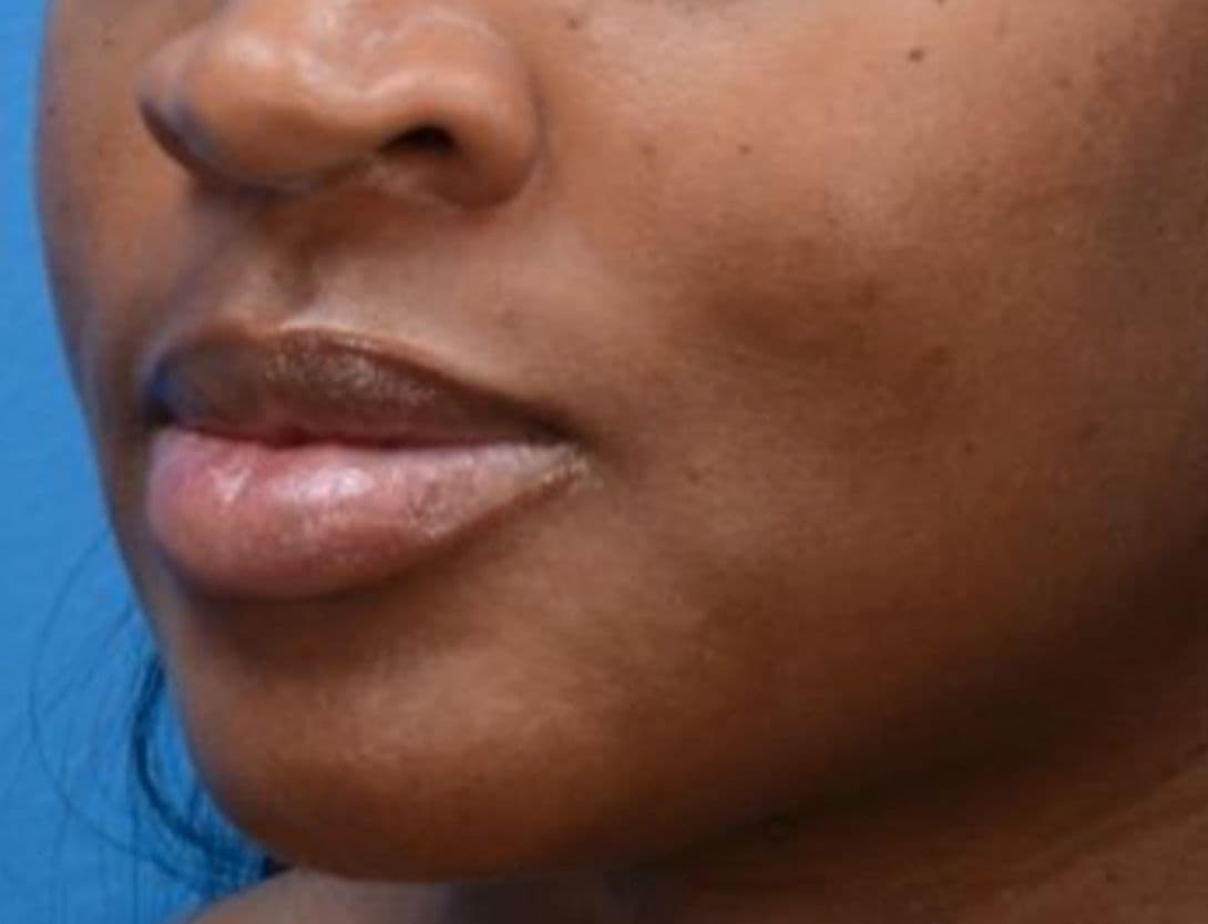 Laser-Resurfacing-1-Before.jpg