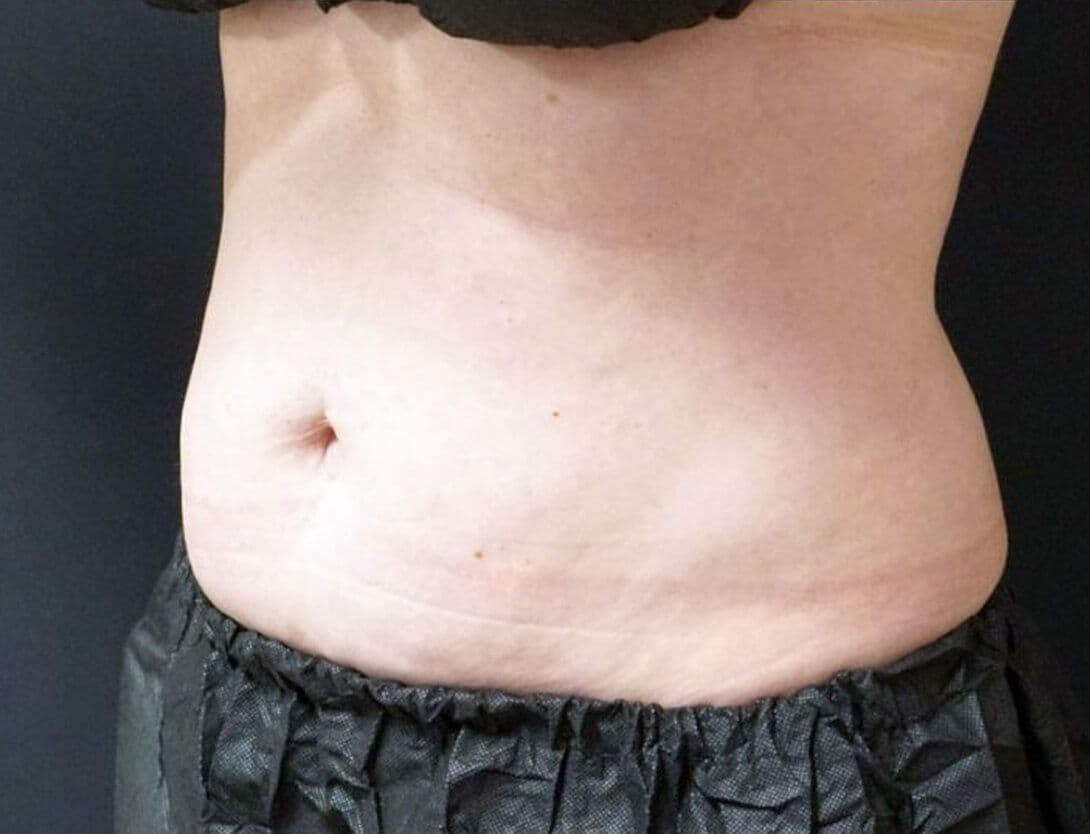 LindsayCoolSculptingB-After.jpg 