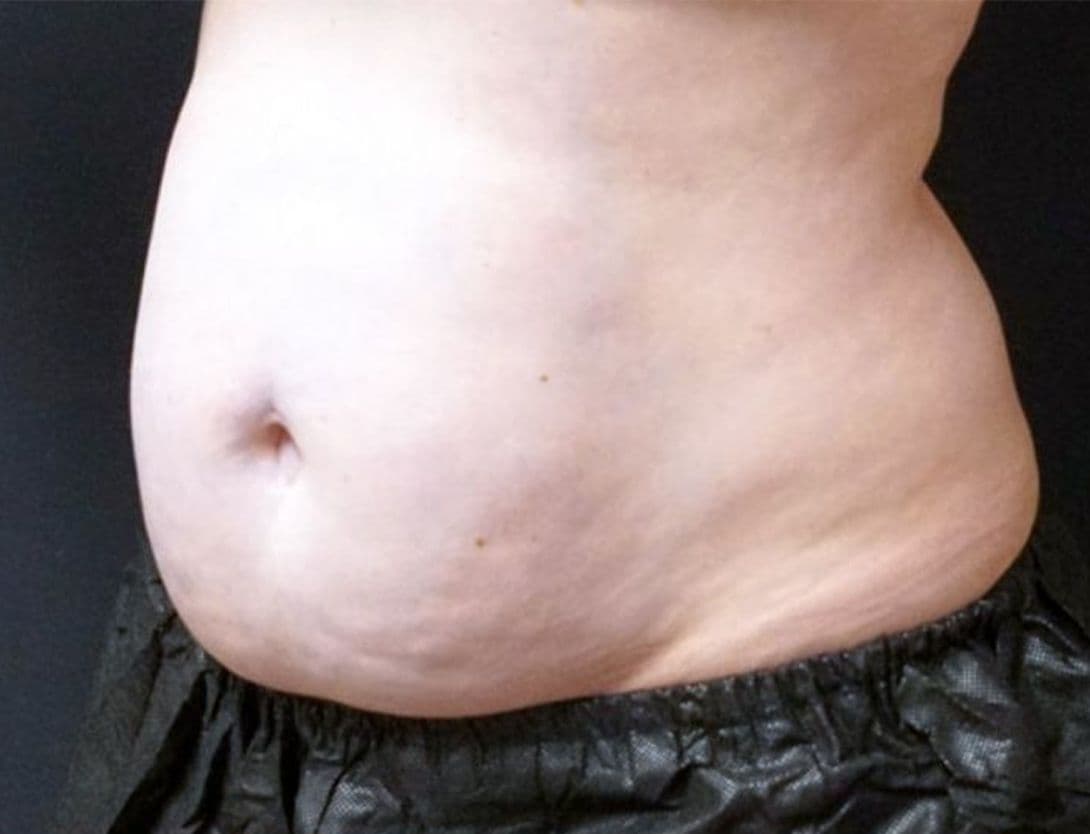 LindsayCoolSculptingB-Before.jpg