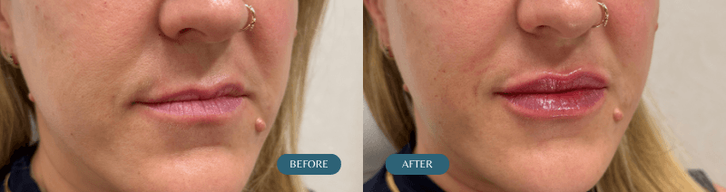 Lip Filler Before & After