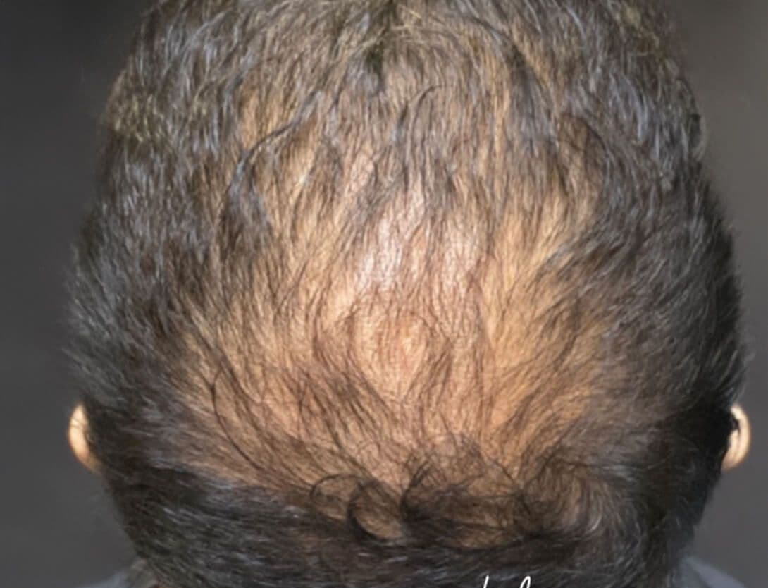 PRP-1-After.jpg