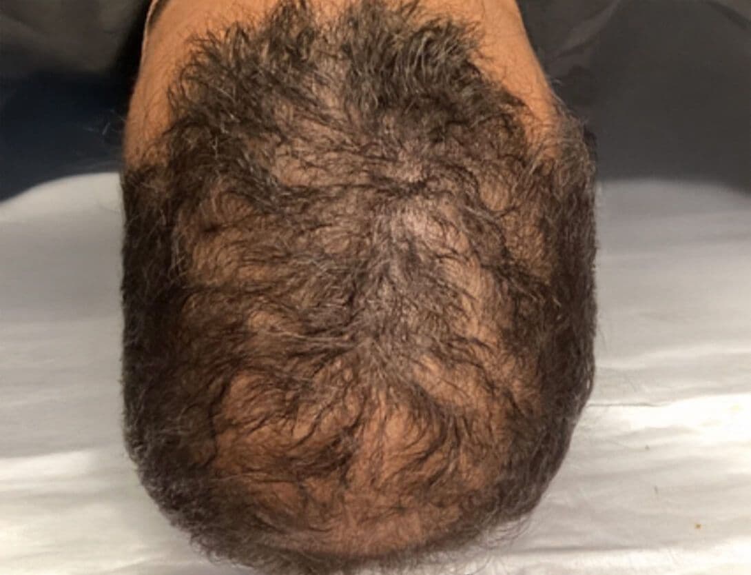 PRP-2-Before.jpg