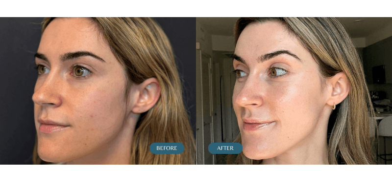 Chantal Microneedling Before and After