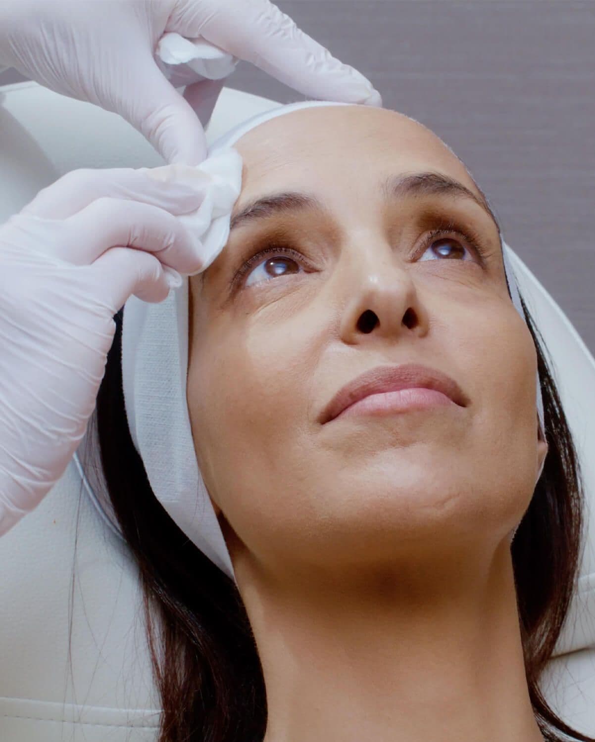 Microneedling