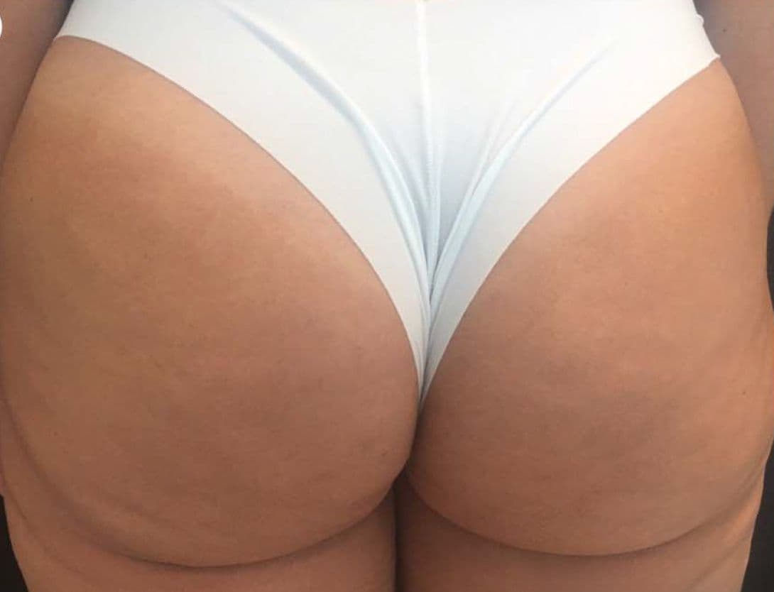 Radiesse-3-Before.jpg