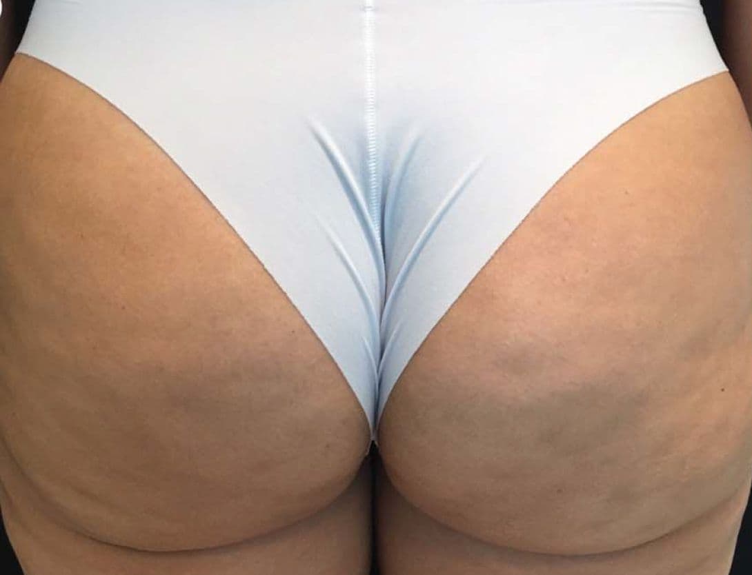Radiesse-3-Before.jpg