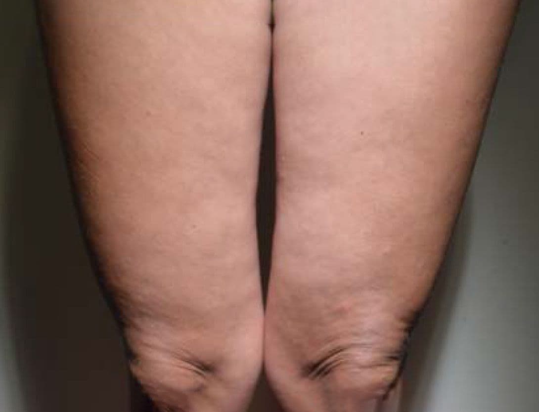 Radiesse-5-After.jpg