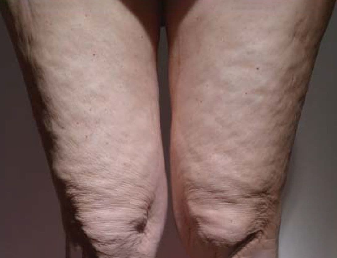 Radiesse-5-Before.jpg
