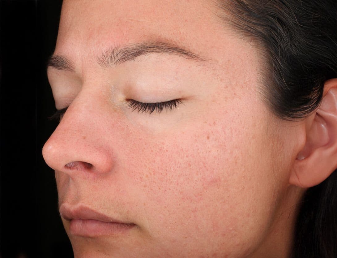 Rejuvenize Peel-1-After.jpg