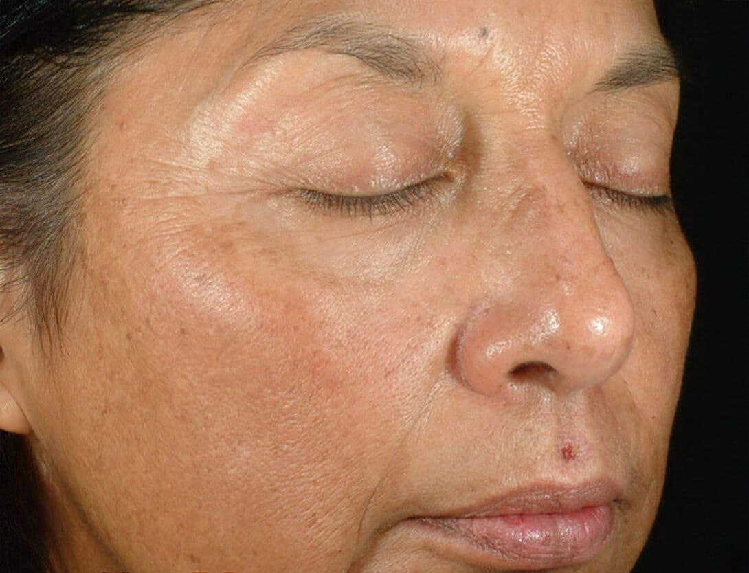 Rejuvenize Peel-2-After.jpg