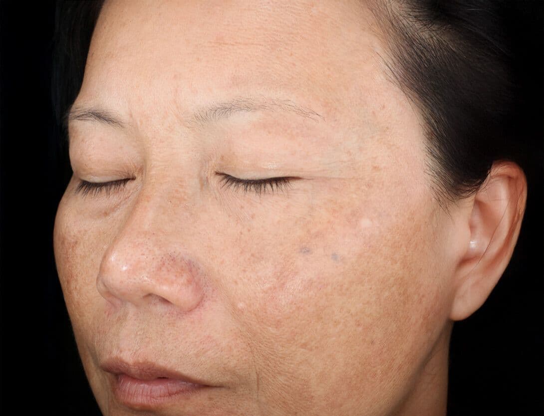 Rejuvenize Peel-3-after.jpg
