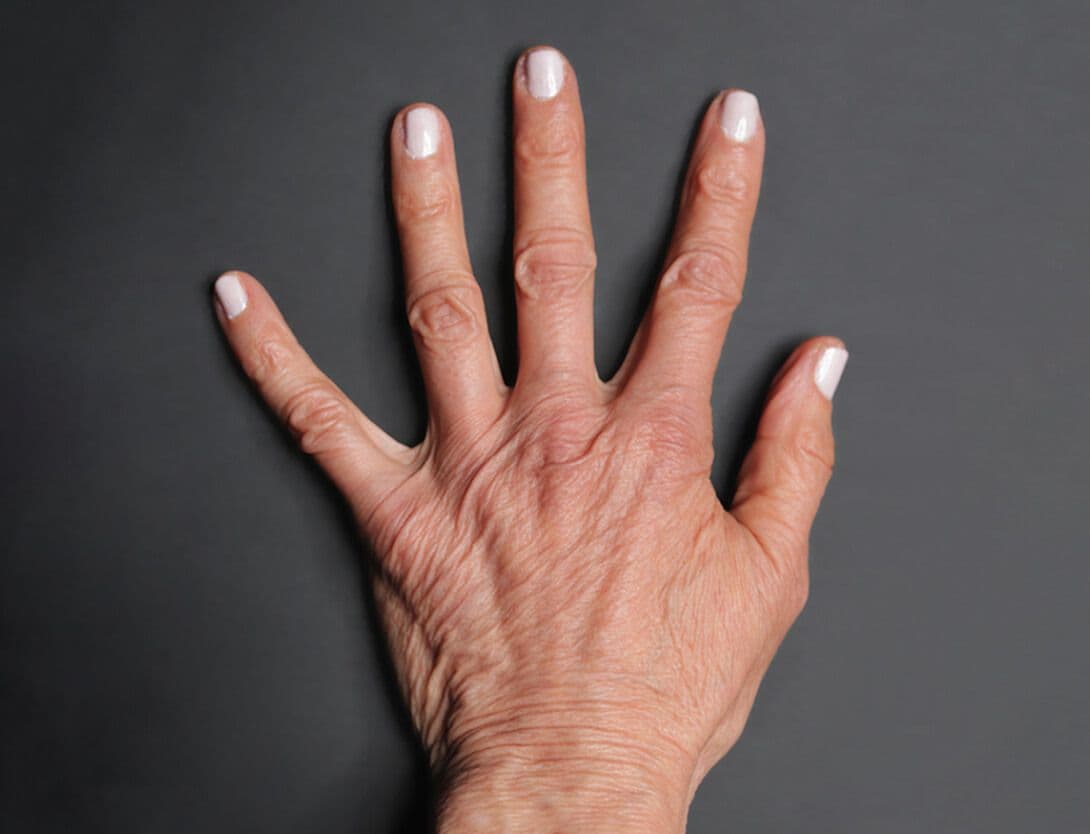 Renuva-B+A-1-Before.jpg