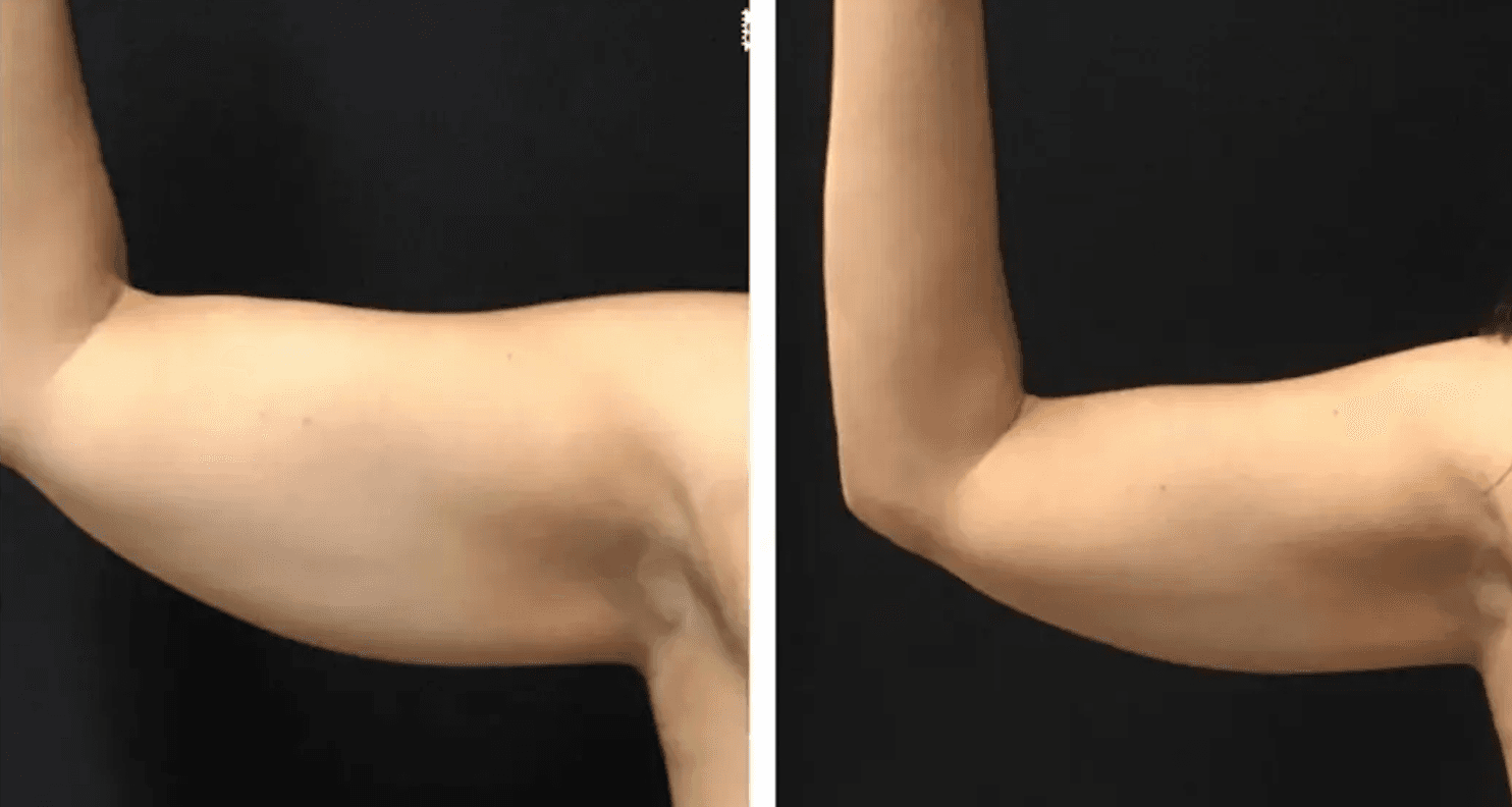 CoolSculpting arms