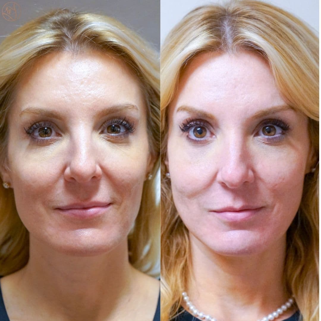 TeresaSculptraB&A (1).jpg