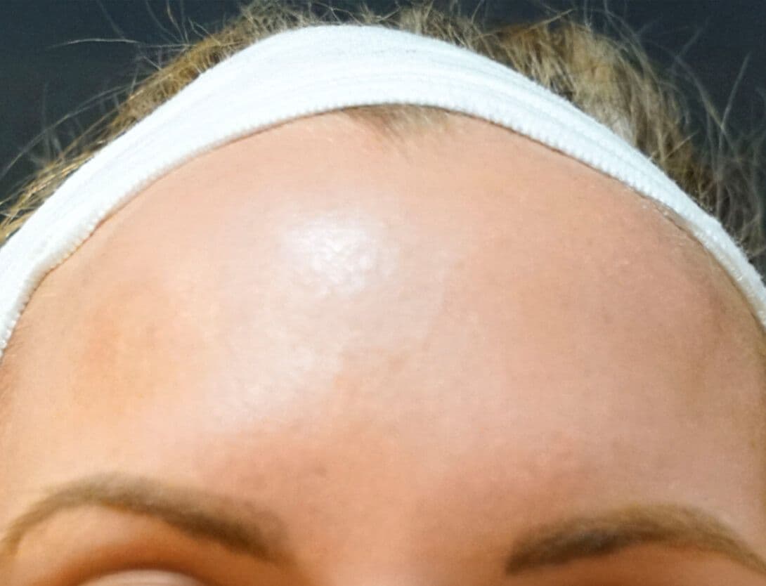 abby_laseMD_close-Before.jpg