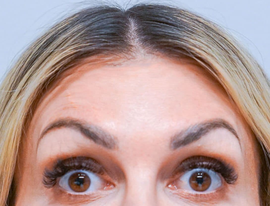 ash_botox_After.