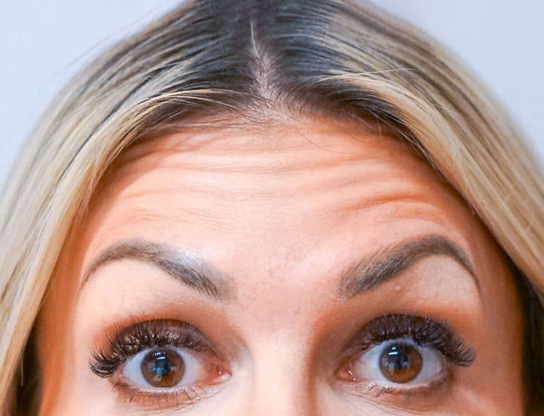 ash_botox