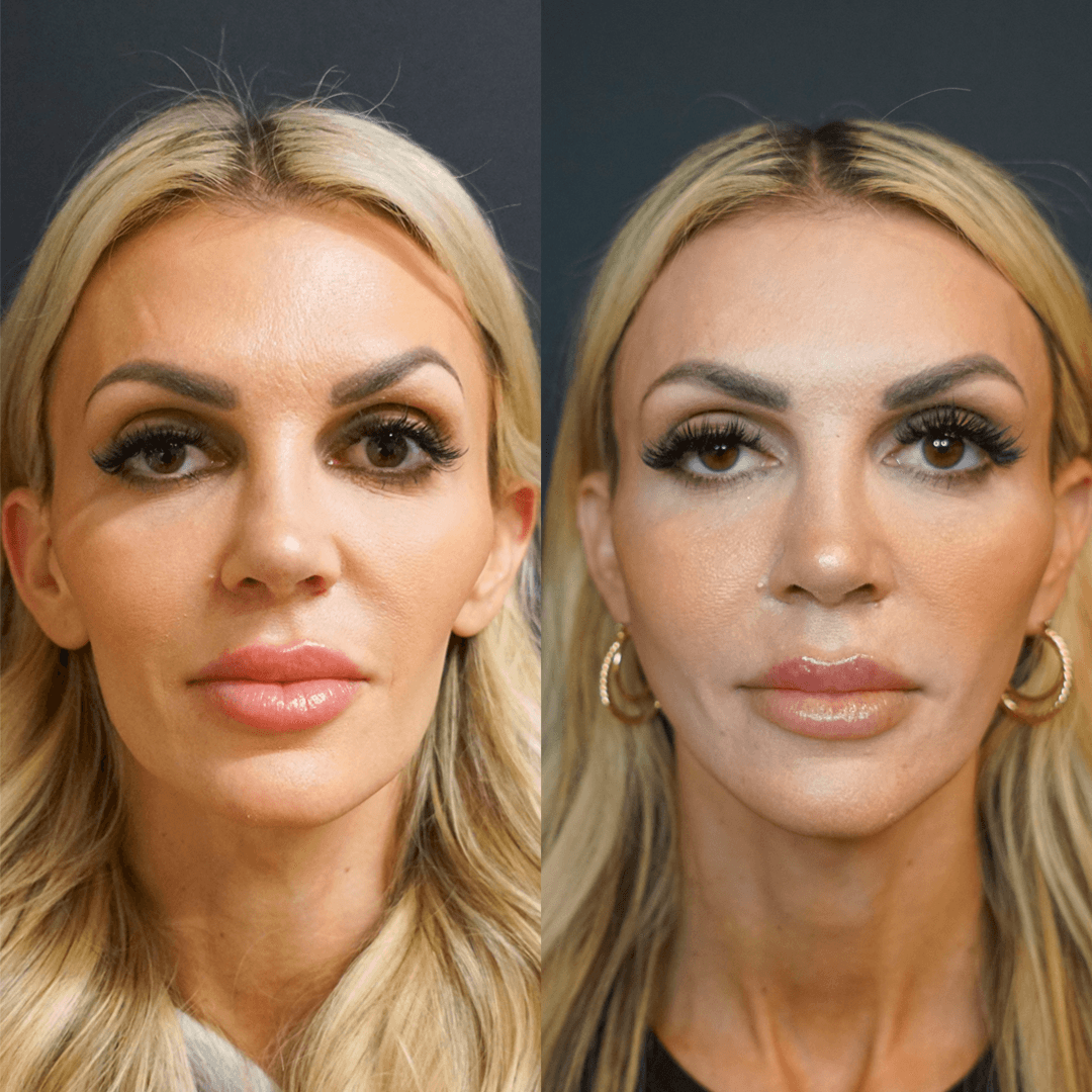 ashley_king_ba_sculptra_filler (3).png