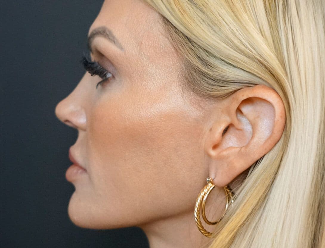 ashley_king_sculptra_filler_side-After.jpg