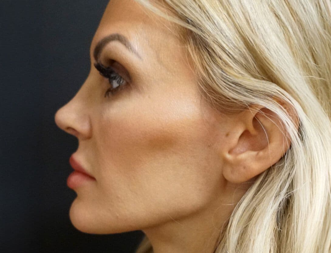 ashley_king_sculptra_filler_side-Before.jpg