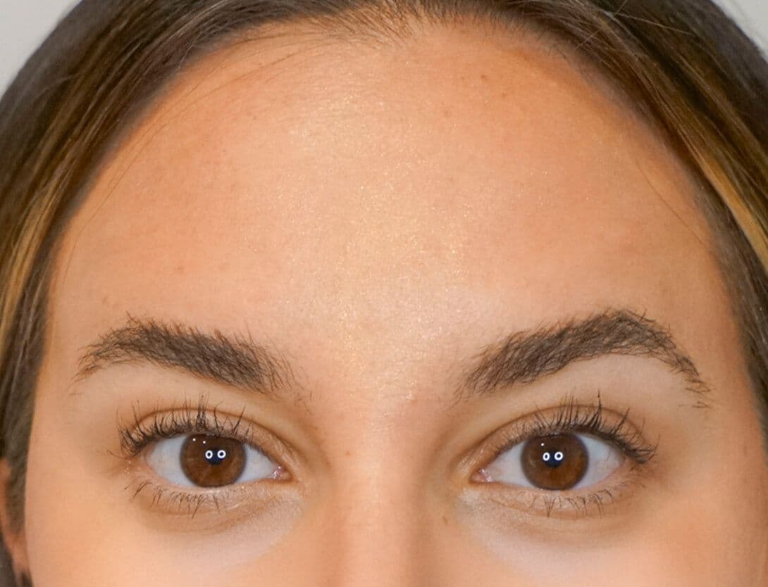 gina_forehead_botox_After.jpg