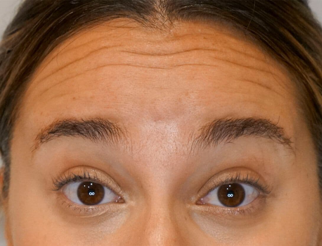 gina_forehead_botox_Before.jpg